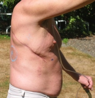 Richard's surgical scars. August, 2006