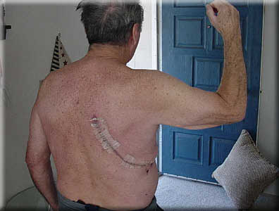 George's Scar Healing. George vows to return to his weight lifting and his former Jack La Laine physique.