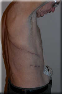 Rob's pleurectomy scar