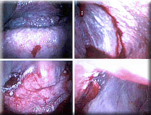 Doug Marr's right lung, post talc pleurodesis March 28, 2002