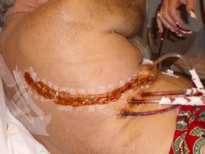 Post surgery, November of 2005