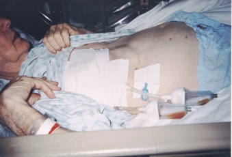 Nicholas' chest tube, post surgery