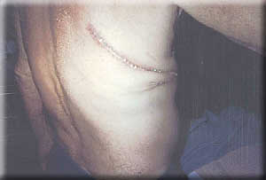 Robert Taylor's surgical scar