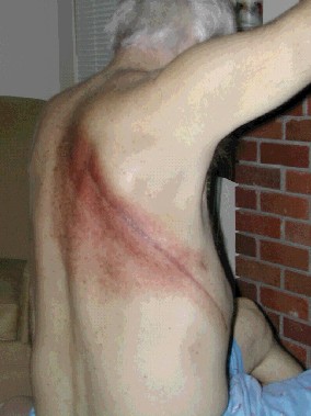 Skin reaction (grade I) standard for medical radiation exposure on Bob's back