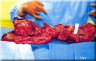 Gary's 14 pound tumor, removed on May 7, 1997